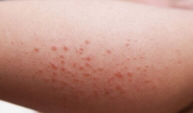 vonkajšie prejavy prítomnosti parazitov v tele